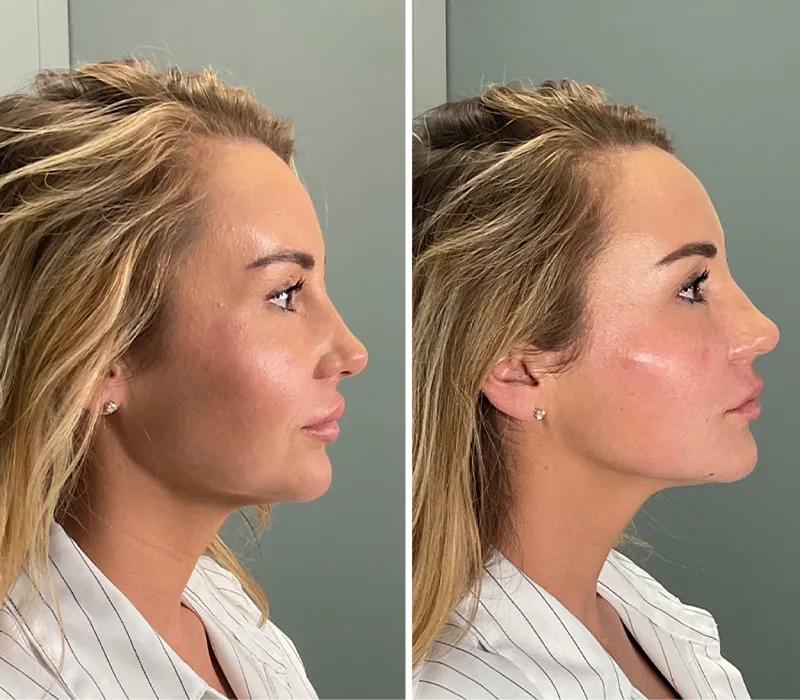 A before and after of a woman who received cheek filler. Her face looks more youthful afterwards.