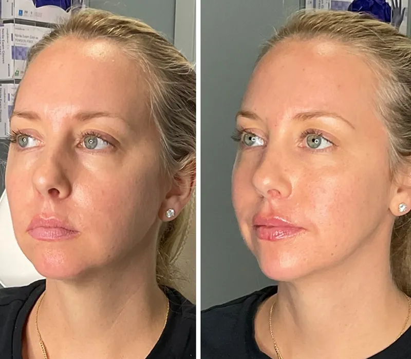 A before and after of a woman who received lip and jaw filler. Her lips are more plump and her jawline is smoother afterwards.