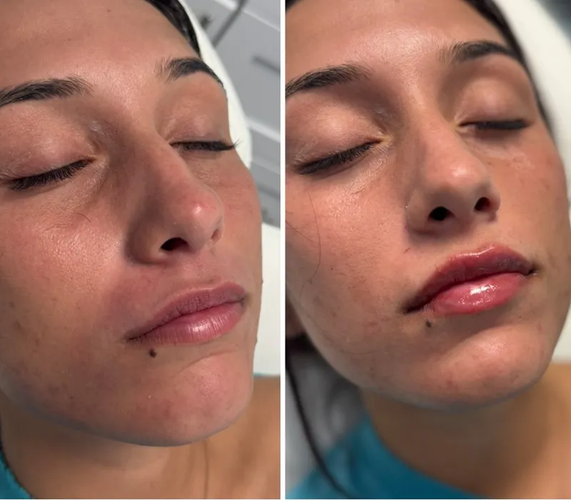 A before and after of a woman who received lip filler. Her lips are more plump afterwards.