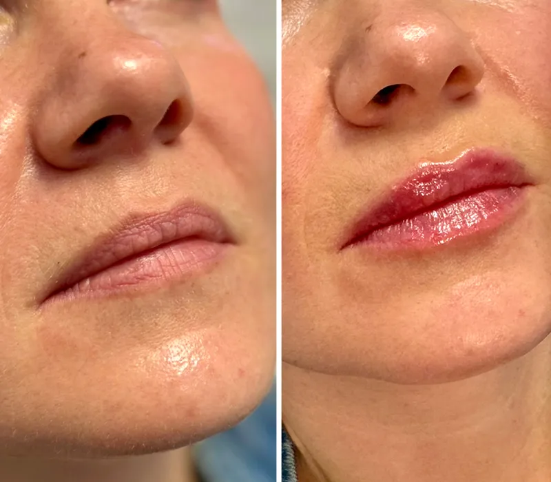 A before and after of a woman who received lip filler. Her lips are more plump afterwards.