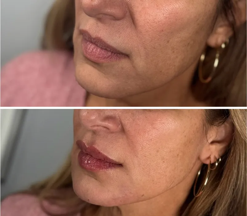 A before and after of a woman who received lip and jaw filler. Her lips are more plump and her jawline is smoother afterwards.